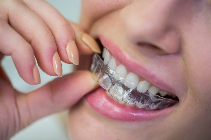 Ce trebuie sa faci dupa indepartarea aparatului dentar