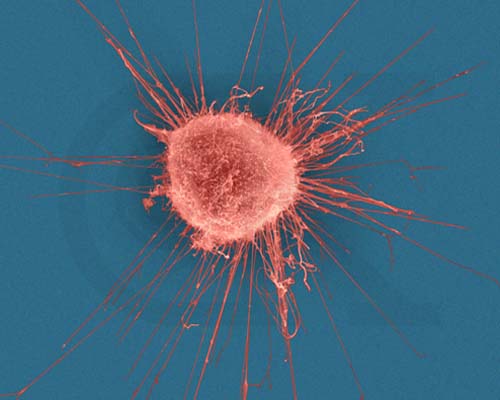 Proteina CPE-delta N, element cheie in lupta impotriva cancerului?