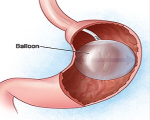 SlimBall, balonul gastric vegetal