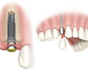 Care sunt avantajele si dezavantajele unui implant dentar