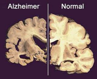 Un vaccin impotriva Alzheimer va fi testat pe oameni incepand din februarie