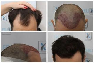 Transplant de par intre pacienti compatibili, la Dr. Felix Hair Implant