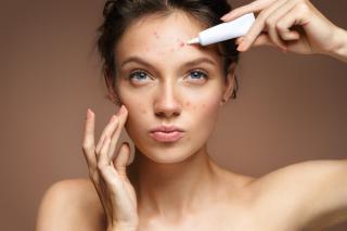 Combaterea acneei: ghidul complet pentru ingrijirea pielii predispuse la acnee