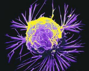 Cancerul poate fi detectat in 6 minute. Romania, prima tara care va realiza scanarea in masa 
