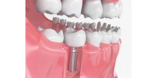 6 tipuri de implanturi dentare disponibile in stomatologie